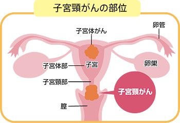 西京病院（京都市 右京区）: 子宮頚がん予防ワクチンについて アーカイブ