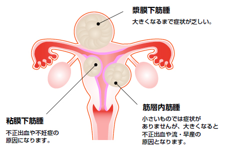 子宮筋腫：病気を知ろう：日本産科婦人科学会