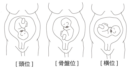 胎位、胎向、胎勢の違い - とある研修医の雑記帳