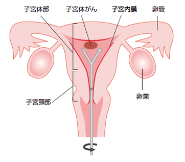 子宮体がん（子宮内膜がん）：病気を知ろう：日本産科婦人科学会