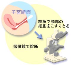 子宮がん検診の勧め：[国立がん研究センター　がん情報サービス]