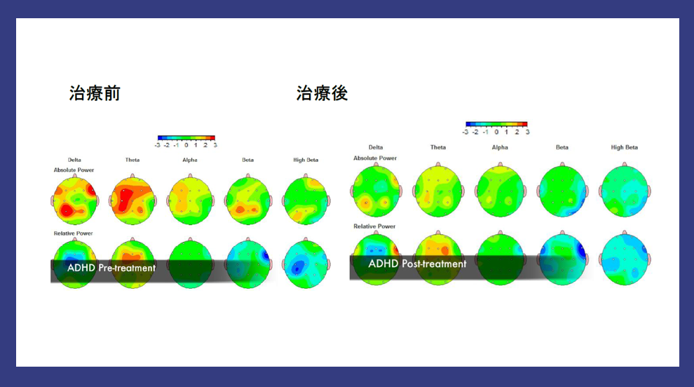 発達障害(ADHD/ASD)の診断【QEEG検査】・治療専門｜ブレインクリニック東京・大阪